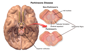 Blausen_0704_ParkinsonsDisease