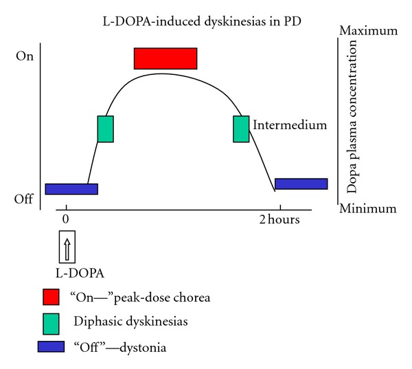 Levodopa-induced dyskinesias